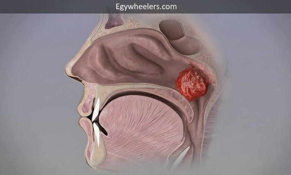 Adenoidid: Complete Guide to Symptoms, Causes, and Effective Treatments